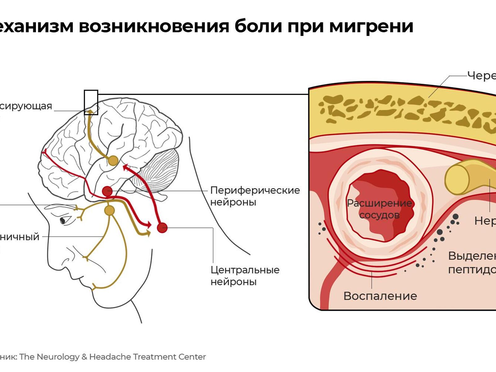 Больные на голову. Ученые нашли возможную причину мигрени - РИА Новости,  20.12.2022