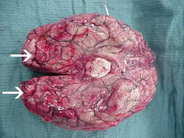 Мозг, пораженный амебой Naegleria fowleri