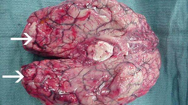 Мозг, пораженный амебой Naegleria fowleri