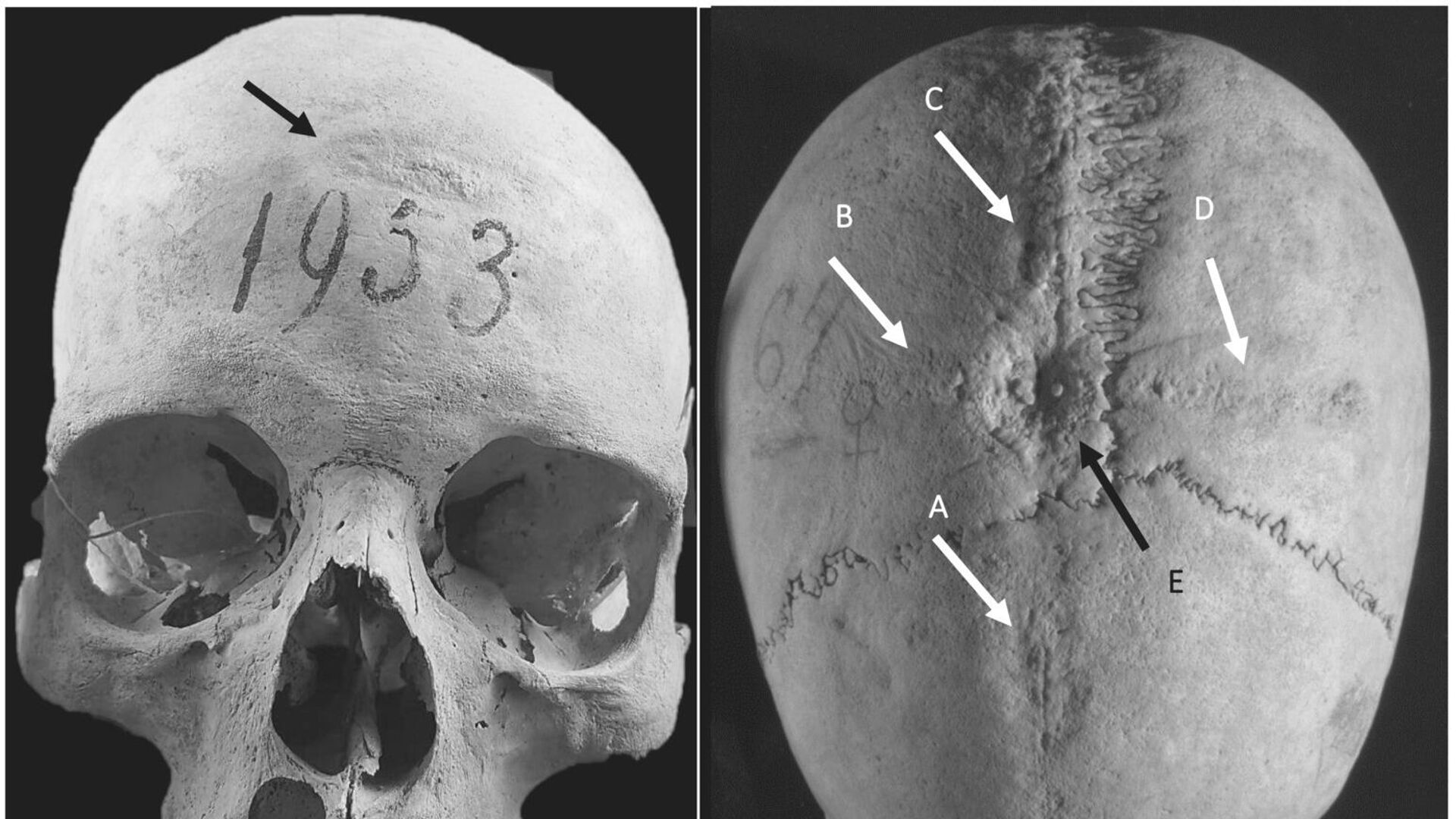 Исследование черепа женщины, жившая 1100 лет назад, перенесшая 2 трепанации  - РИА Новости, 1920, 15.02.2023