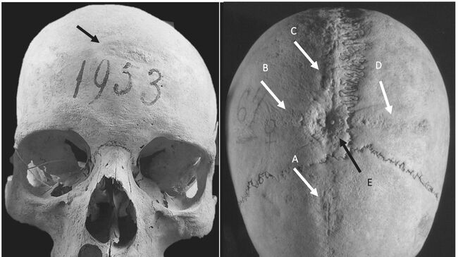 Исследование черепа женщины, жившая 1100 лет назад, перенесшая 2 трепанации 
