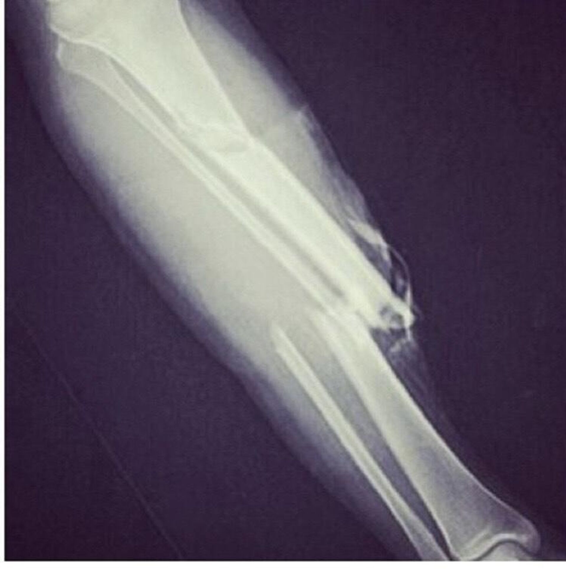 X-ray of Kevin Ware's leg after fracture - RIA Novosti, 1920, 24.03.2023