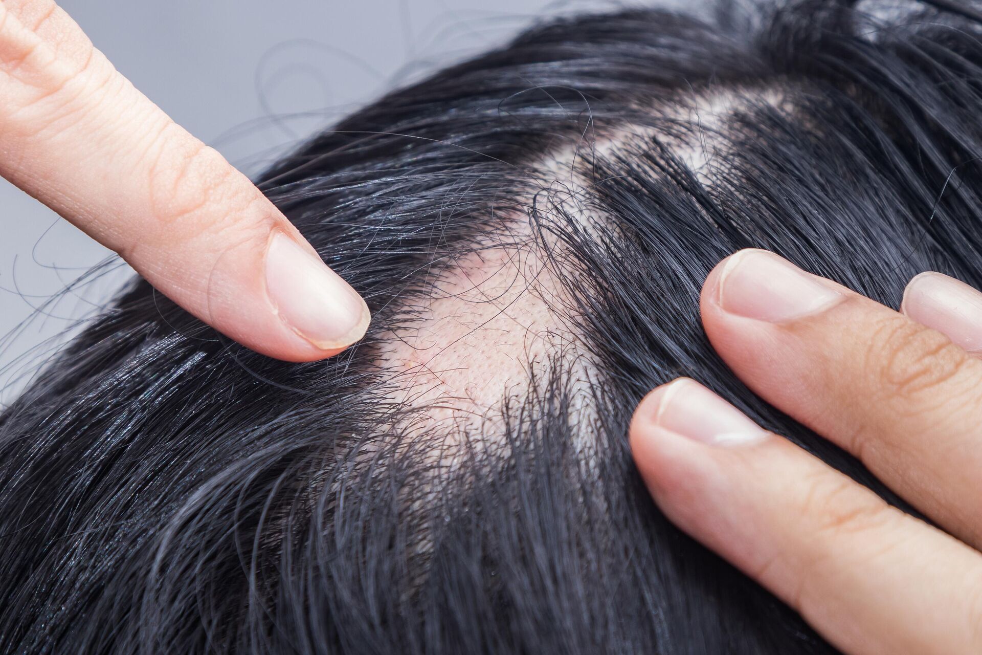 Как уменьшить выпадение волос? Правила и рекомендации врача