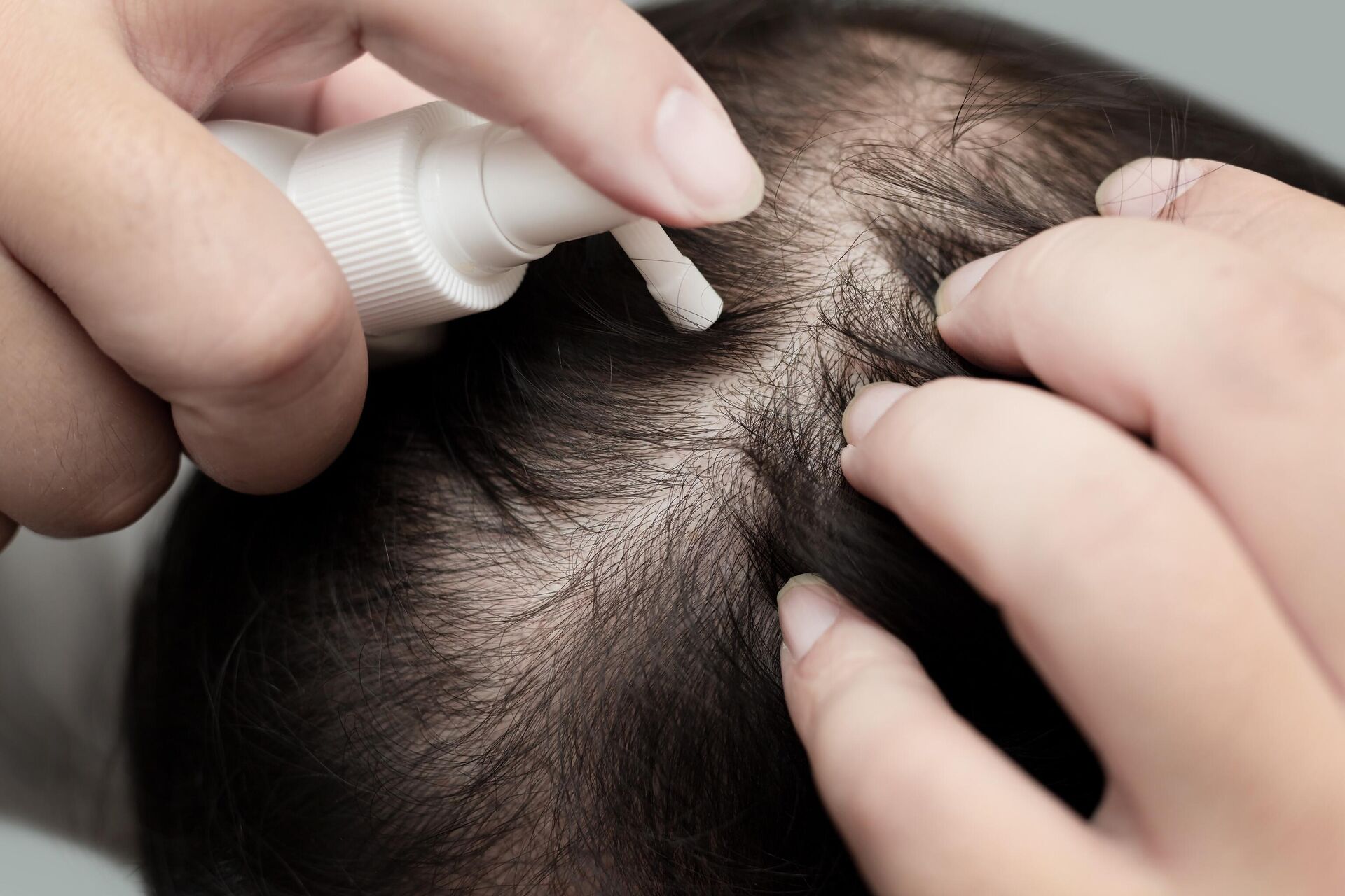 Выпадение волос у женщин — лечение с помощью пересадки волос