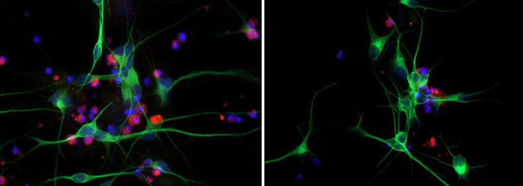 Нейроны человека, полученные из индуцированных плюрипотентных стволовых клеток пациентов с БАС (зеленым — активированные нейроны, синим — ядра клеток, красным — умирающие клетки) - РИА Новости, 1920, 27.04.2023