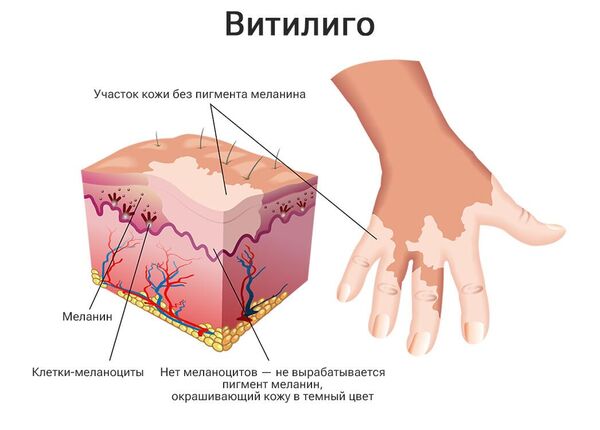 Витилиго: лечение, причины, симптомы - все о заболевании узнайте у врача клиники МЕДСИ