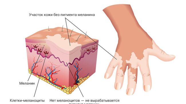 Механизм возникновения витилиго