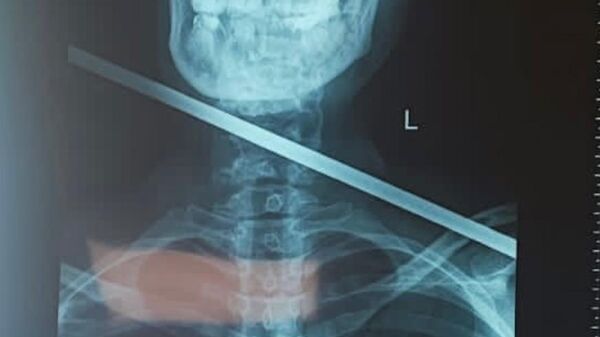Рентгеновский снимок шеи жительницы Приморья, в которую выстрелили из гарпуна