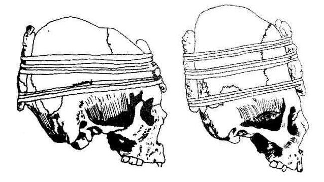 Один из способов искусственной деформации черепа, используемых представителями культуры Паракас