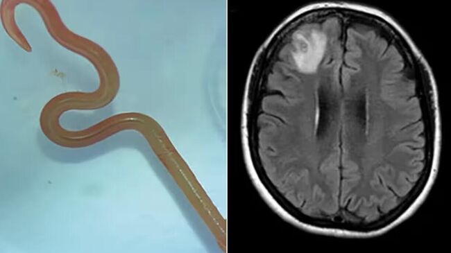 Круглый червь, которого извлекли из мозга человека в Австралии