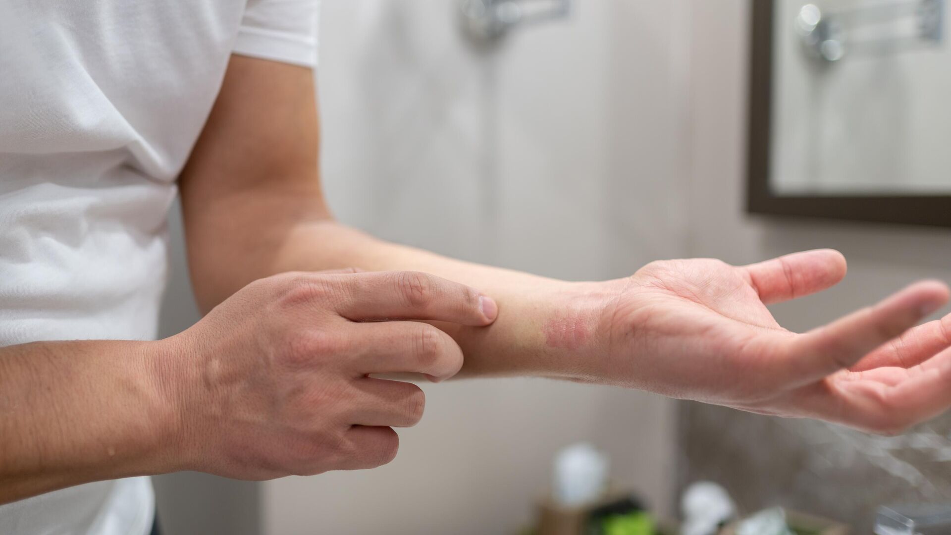 Ожоги кожи: правила первой помощи и лечения