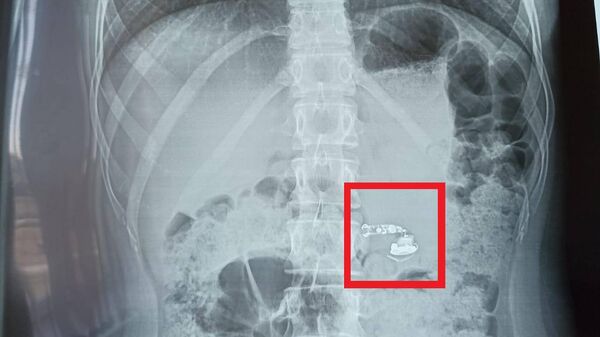 Рентген брюшной полости школьницы, проглотившей во сне беспроводной наушник