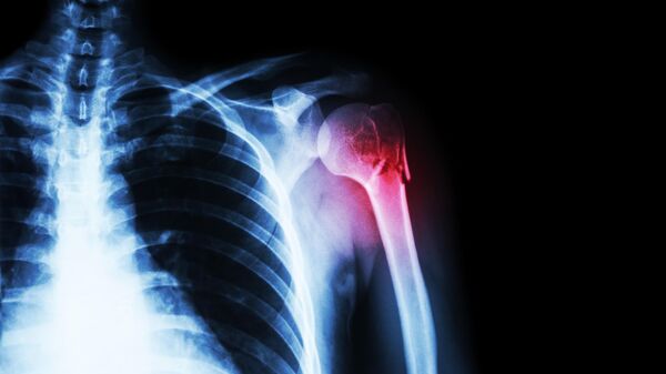Рентген перелома плечевой кости
