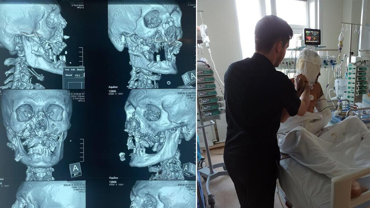 В Хакасии спасли лицо сборщика орехов, пострадавшего от нападения медведя -  РИА Новости, 23.09.2023