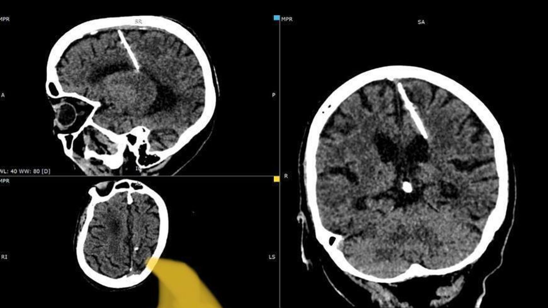 Инородное тело на снимке головного мозга 80-летней пациентки на Сахалине - РИА Новости, 1920, 04.10.2023