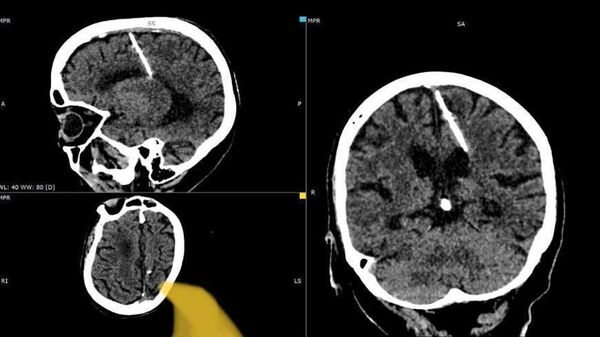 Инородное тело на снимке головного мозга 80-летней пациентки на Сахалине