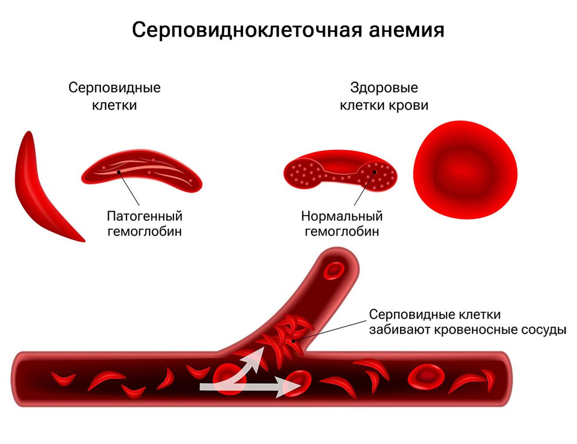 Ген серповидноклеточной анемии. Серповидноклеточная анемия.