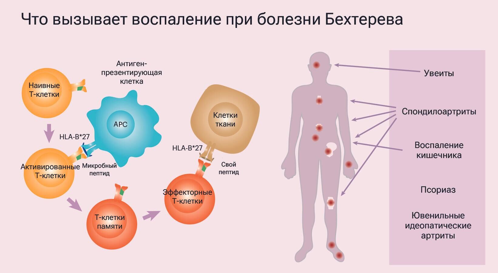 Что вызывает воспаление при болезни Бехтерева - РИА Новости, 1920, 24.11.2023