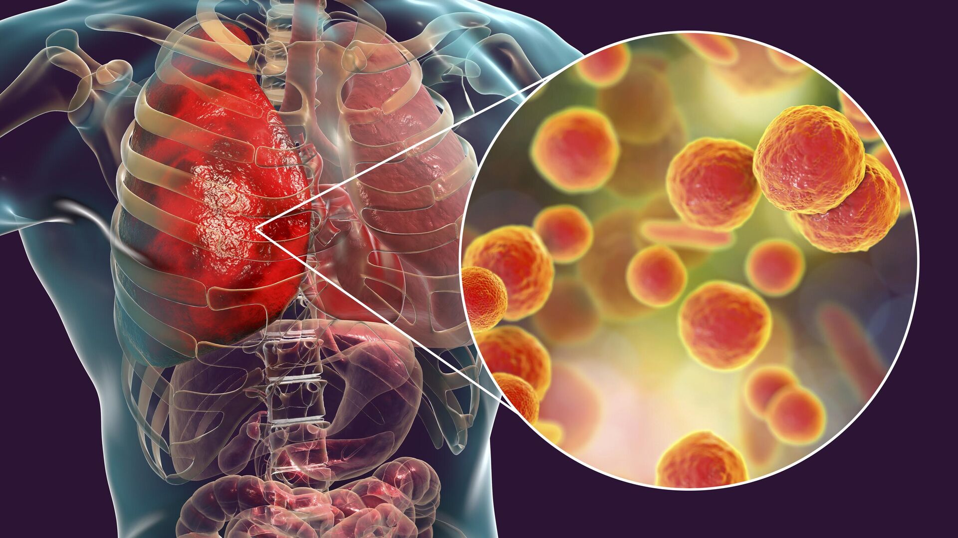 Инфекция легких, вызванная бактериями Mycoplasma pneumoniae - РИА Новости, 1920, 06.12.2023