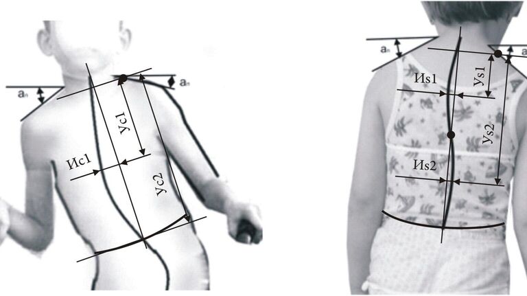 Схема измерения дополнительных размерных признаков детей с искривлением позвоночника, необходимых для модификации ТБК в конструкцию на фигуру ребенка с ДЦП