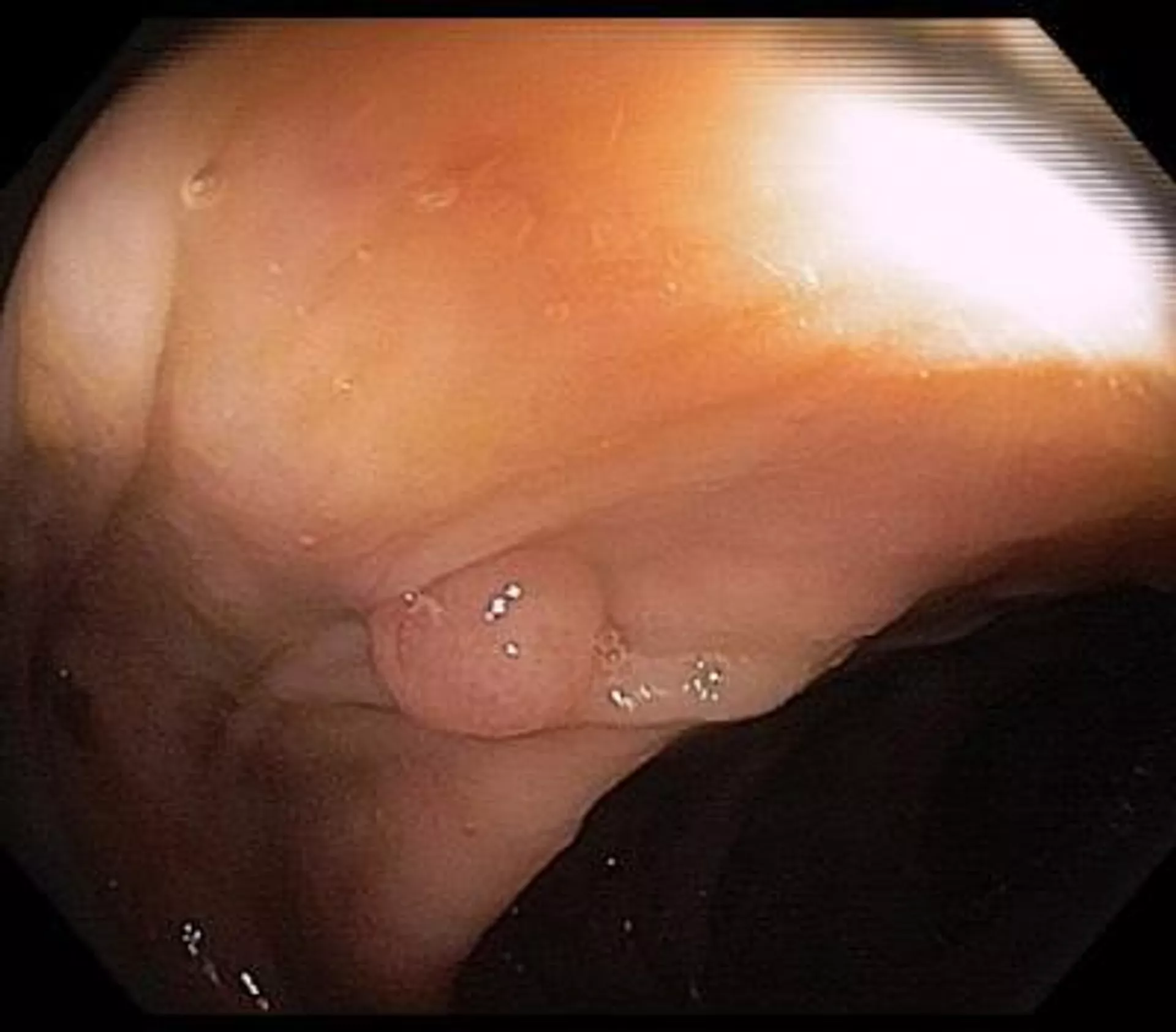 Полип в кишечнике обнаружен во время колоноскопии — это фактор развития рака