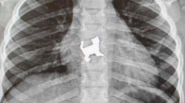 Рентгеновский снимок девочки, проглотившей металлическую игрушку в форме кошки