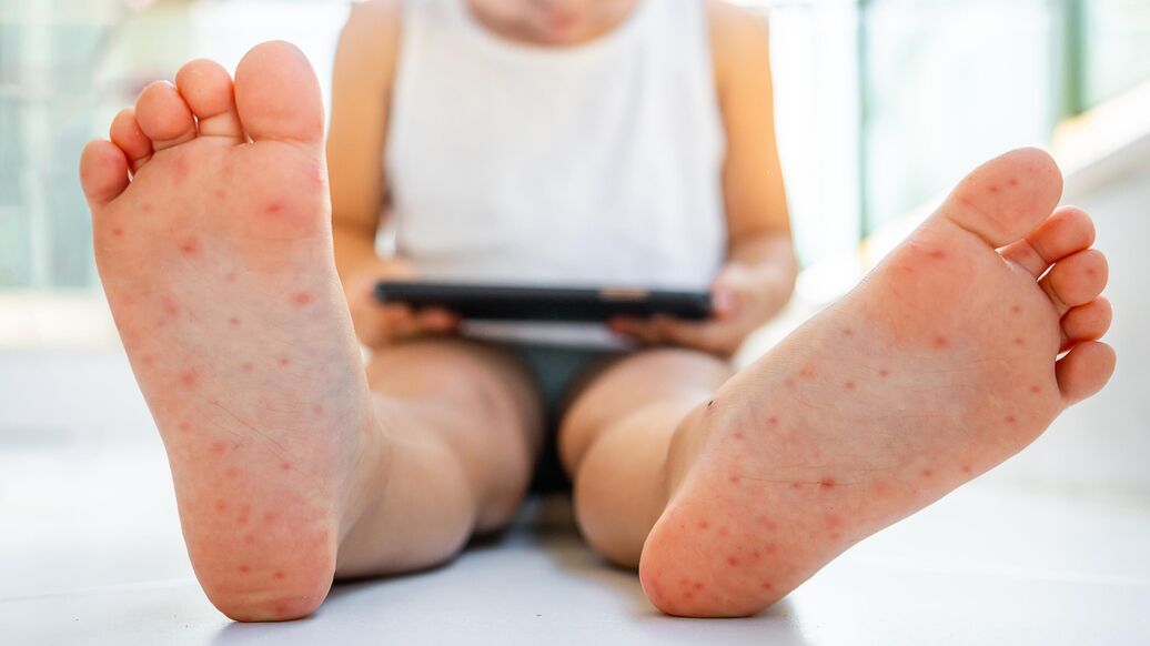 Роспотребнадзор опроверг сообщения о массовых вспышках Коксаки в России