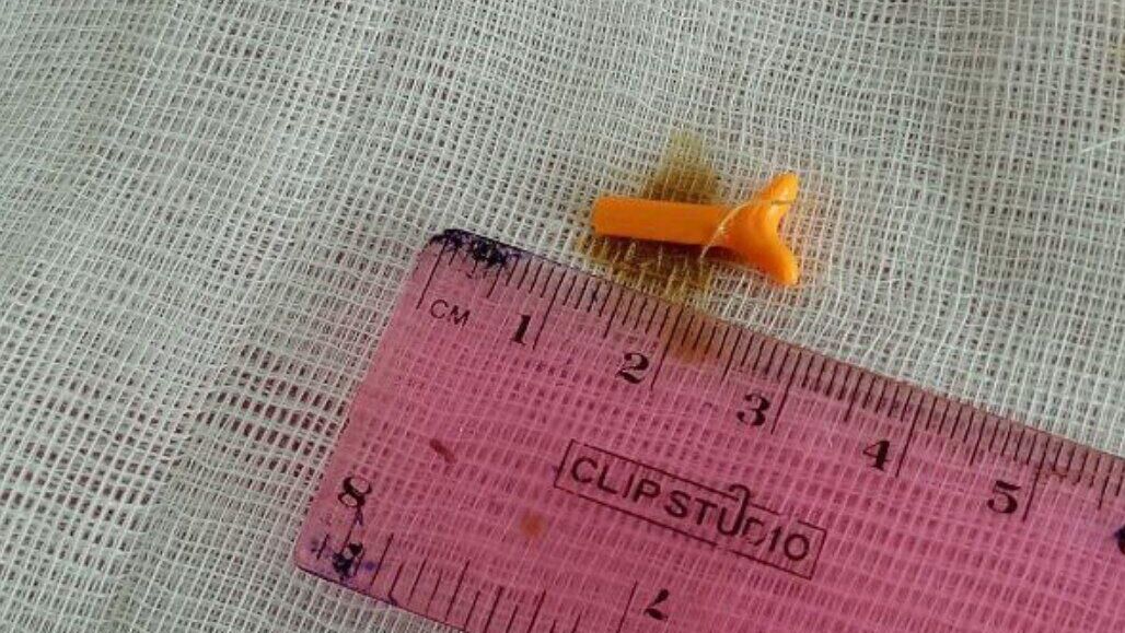 Деталь от конструктора Лего, которую извлекли из уха пациентки в горбольнице Прокопьевска Кемеровской области - РИА Новости, 1920, 21.01.2025