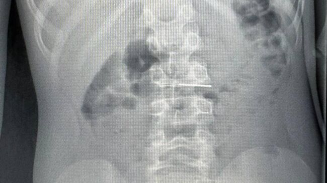 Врачи Центра Рошаля спасли ребенка, проглотившего иголку
