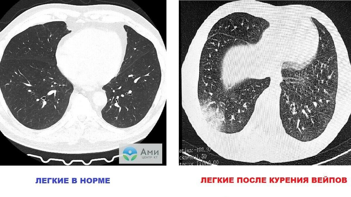 Томографический снимок попкорновой болезни - РИА Новости, 1920, 19.03.2025