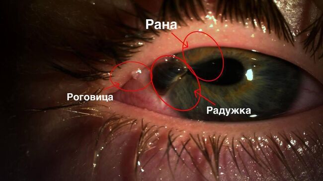 Врачи Детского клинического центра имени Л. М. Рошаля спасли зрение 10-летнему мальчику, в глаз которого попали осколки стекла