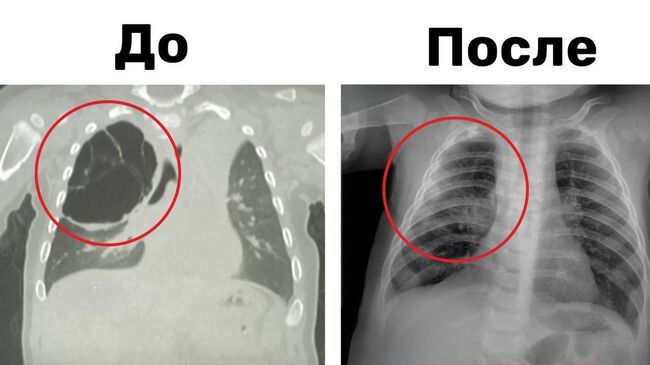 15-сантиметровую кисту легкого удалили 8-месячному малышу в Детском центре им. Л.М. Рошаля 15-сантиметровую кисту легкого удалили 8-месячному малышу в Детском центре им. Л.М. Рошаля