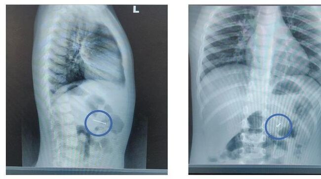 Гвоздь в желудке ребенка