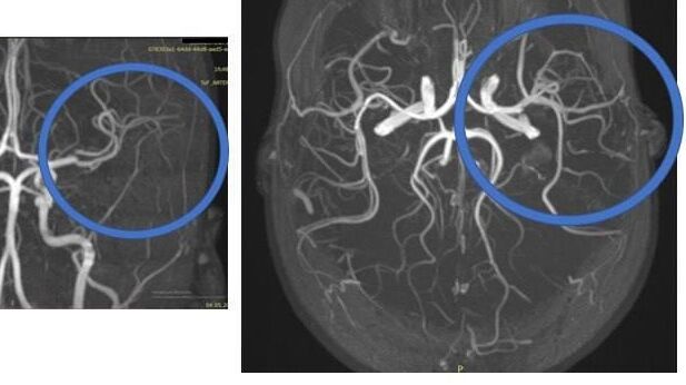Врачи подмосковного Детского клинического центра имени Л.М. Рошаля спасли 10-летнюю девочку от инсульта - РИА Новости, 1920, 28.05.2025