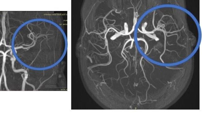 Врачи подмосковного Детского клинического центра имени Л.М. Рошаля спасли 10-летнюю девочку от инсульта