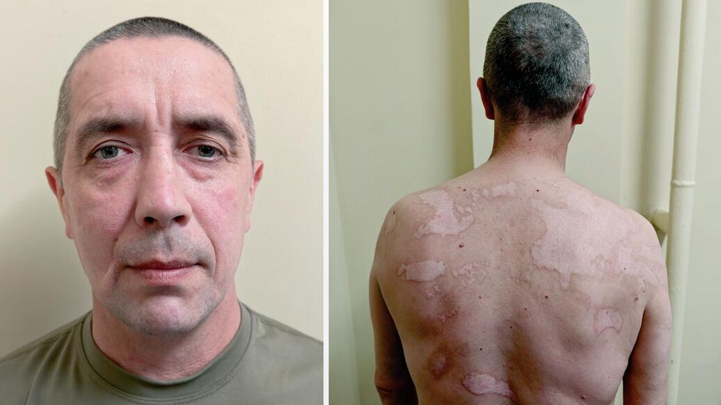 Российские бойцы, вернувшиеся из украинского плена, рассказали о пытках