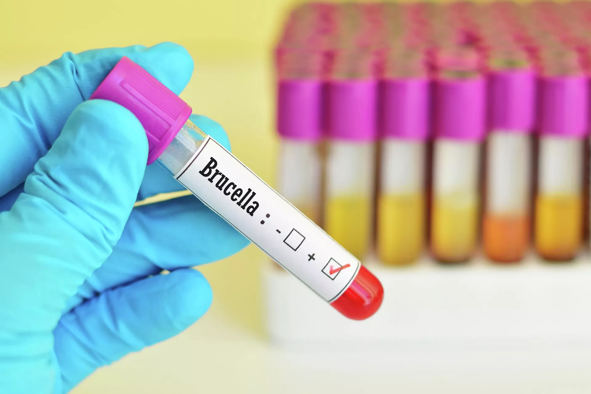 Positive blood test for Brucella infection