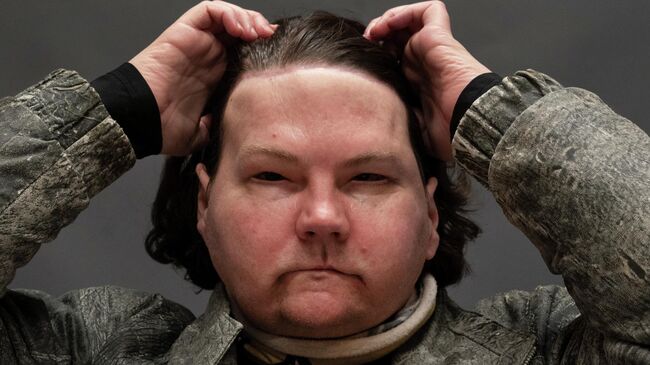 Американец Джо Димео, которому пересадили чужое лицо и обе руки после аварии