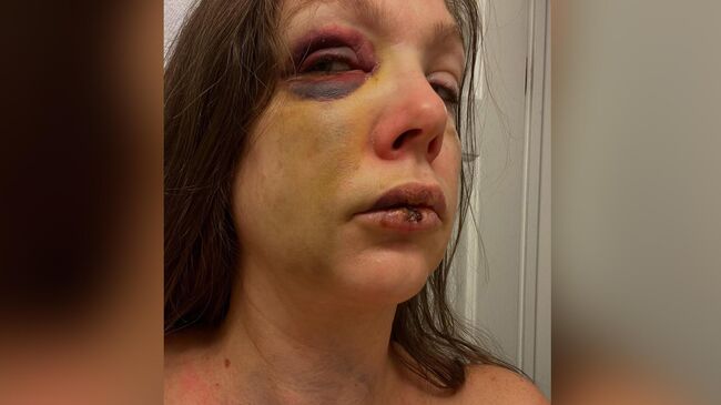 Россиянка, ставшая жертвой жестокого избиения во время массовой драки в американском городе Цинциннати