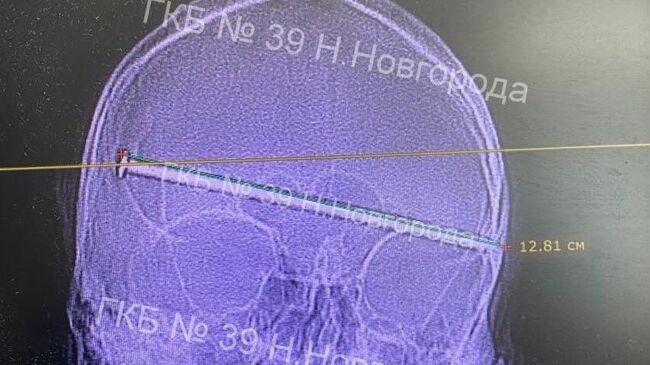 Нейрохирурги больницы №39 в Нижнем Новгороде спасли мужчину, голову которого пробил огромный гвоздь