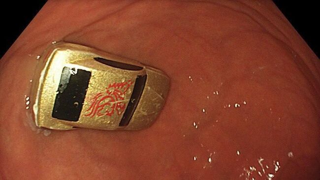 Игрушка, которую проглотил ребенок в Подмосковье