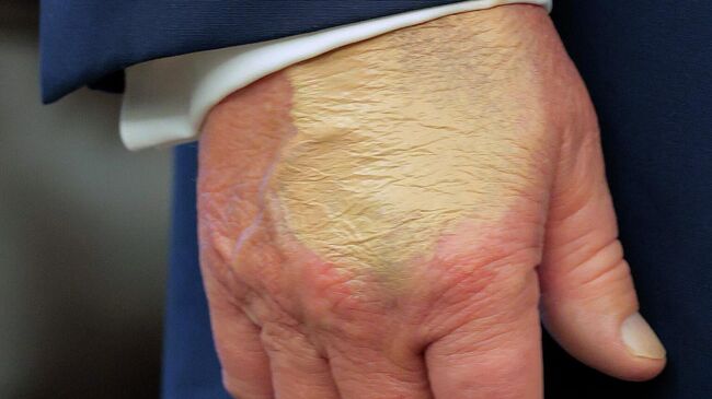 Cиняк, покрытый плотным слоем тонального крема, на правой руке президента США Дональда Трампа