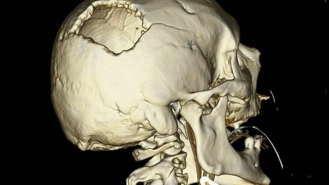 Черепно-мозговая травма в результате удара стрелой крана