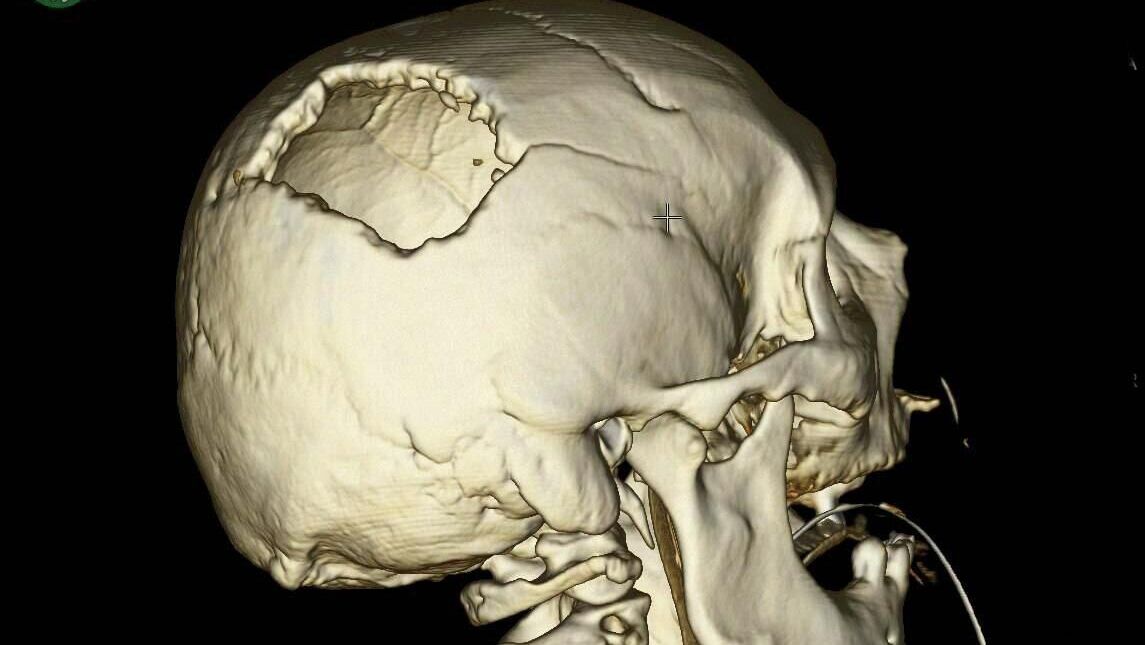 Черепно-мозговая травма в результате удара стрелой крана - РИА Новости, 1920, 04.09.2025