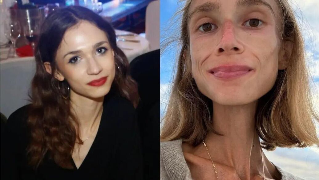 Весила 23 килограмма и ела только одно: как диета убила молодую девушку