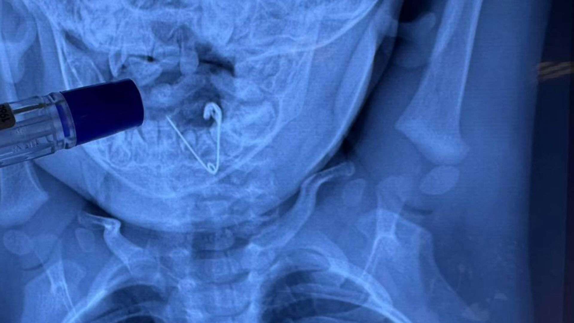 Врачи во Владивостоке спасли проглотившего булавку-оберег 7-месячного ребенка - РИА Новости, 1920, 30.10.2025