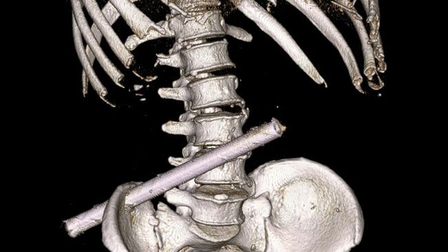 Врачи из Новочебоксарска спасли мужчину, вытащив 25-сантиметровую трубу, воткнувшуюся ему в тело при падении