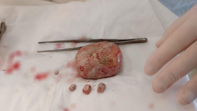 Гигантский камень извлекли врачи городской больницы во время операции в Балаково Саратовской области