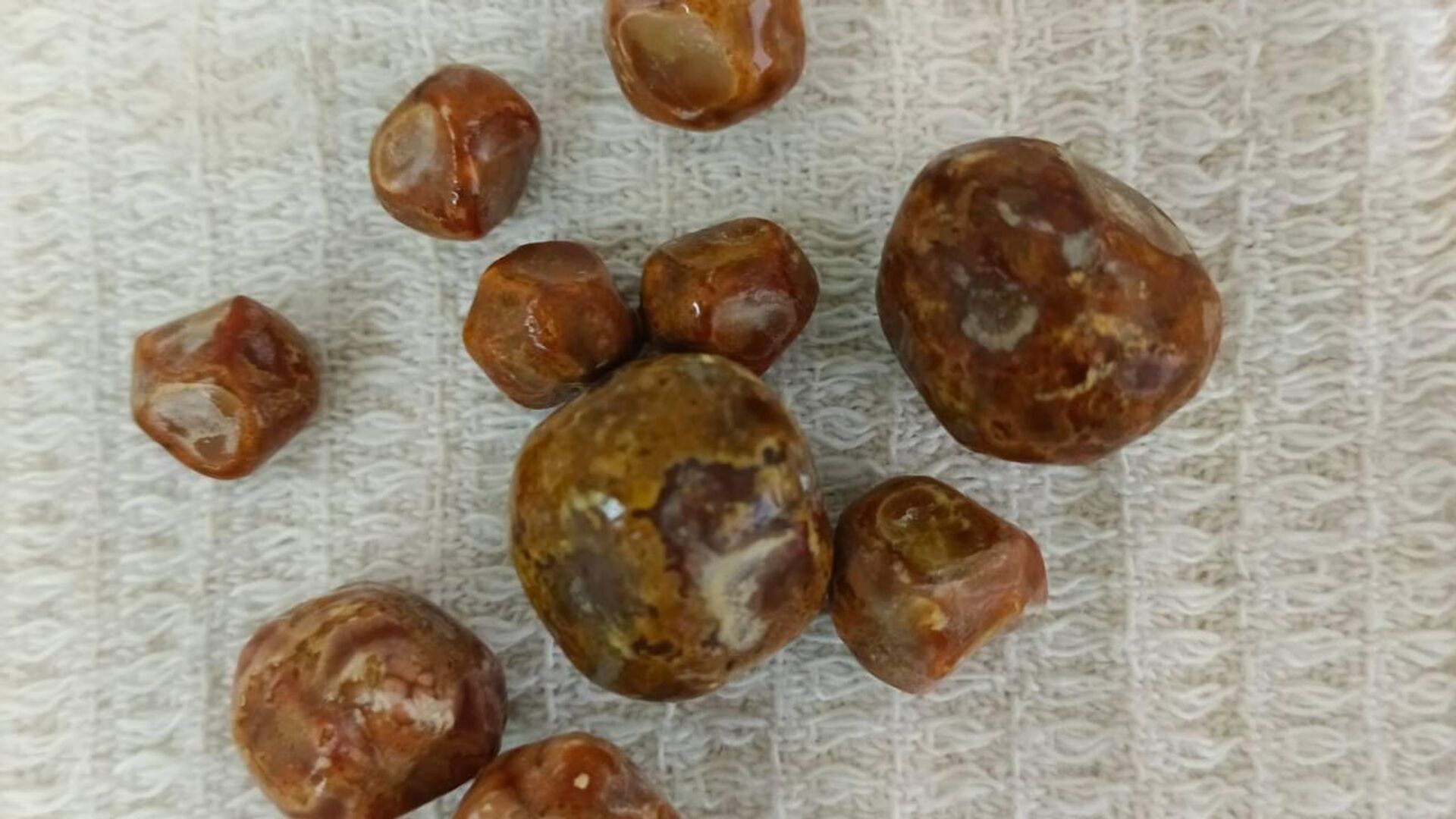 Врачи в Саратовской области удалили в ходе операции из желчного пузыря подростка десять крупных камней - РИА Новости, 1920, 28.11.2025