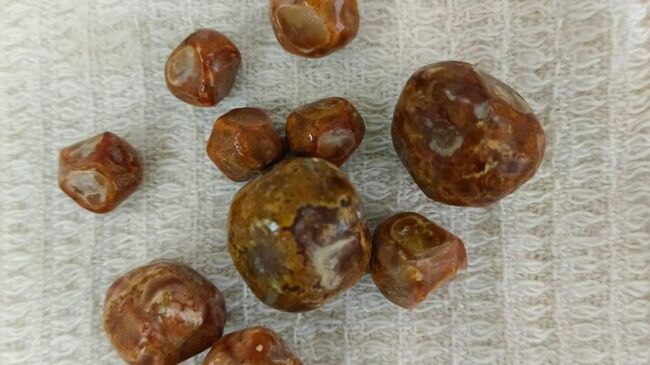 Врачи в Саратовской области удалили в ходе операции из желчного пузыря подростка десять крупных камней